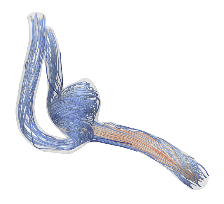 Fluid flow inside an aneurysm